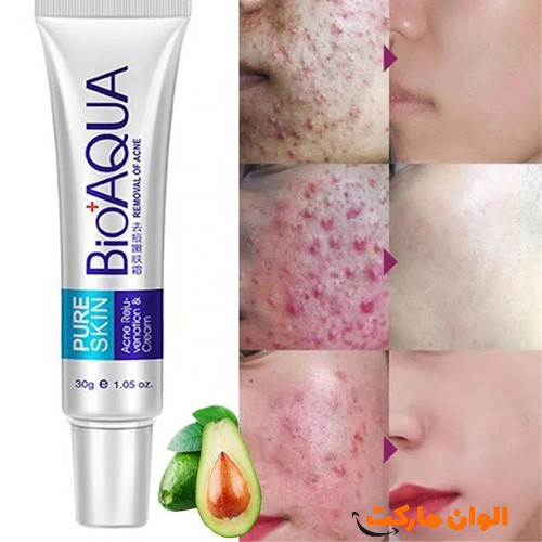 خرید-کرم-درمانی-ضدجوش-و-ضدلک-بیواکوا-bioaqua-کد-g-3020-تهران-